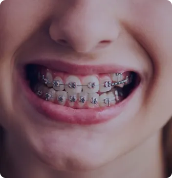 rostro de mujer mostrando dentadura con brackets